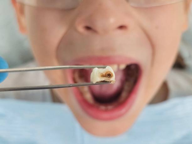 Best Emergency Dental Care for Broken or Chipped Teeth in Fairbanks, AK